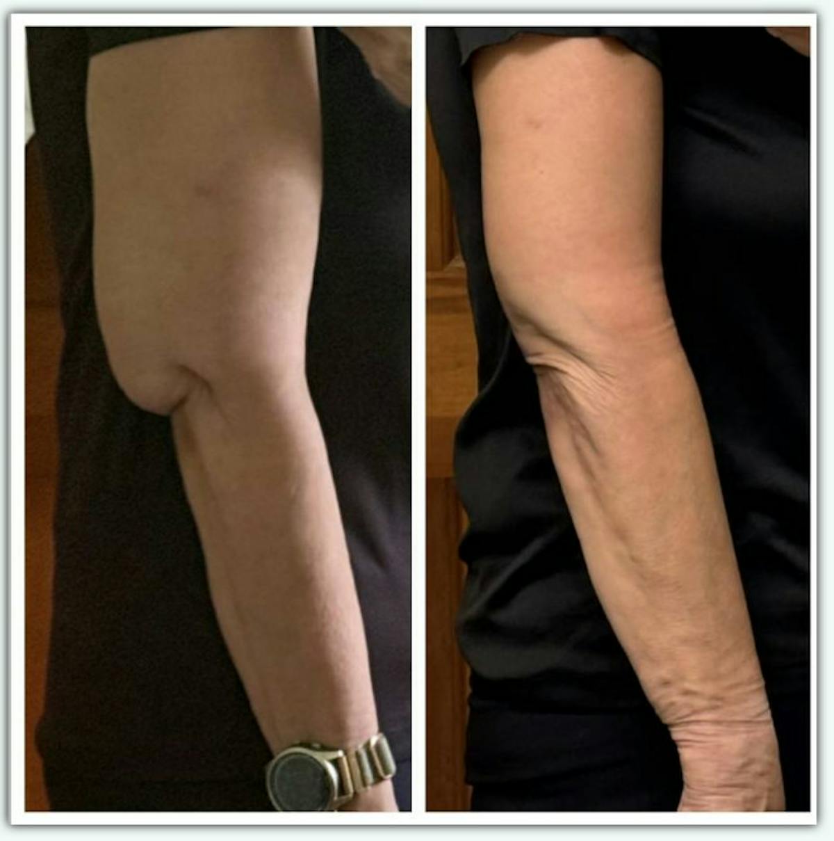 Arm Lift / Thigh Lift Before & After Gallery - Patient 137519 - Image 1