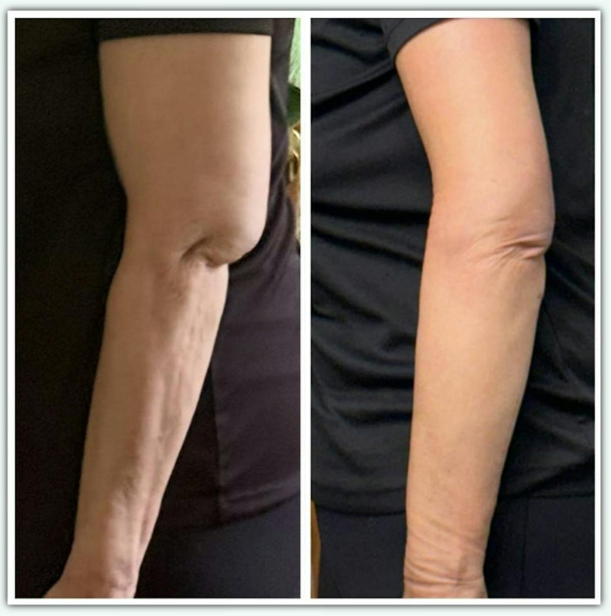 Arm Lift / Thigh Lift Before & After Gallery - Patient 137519 - Image 2
