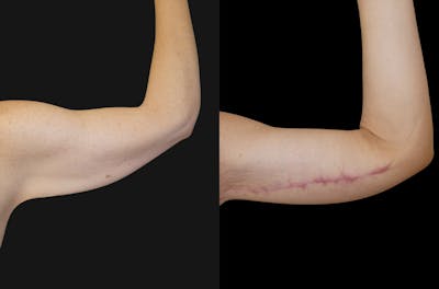 Arm Lift / Thigh Lift Before & After Gallery - Patient 149895 - Image 1