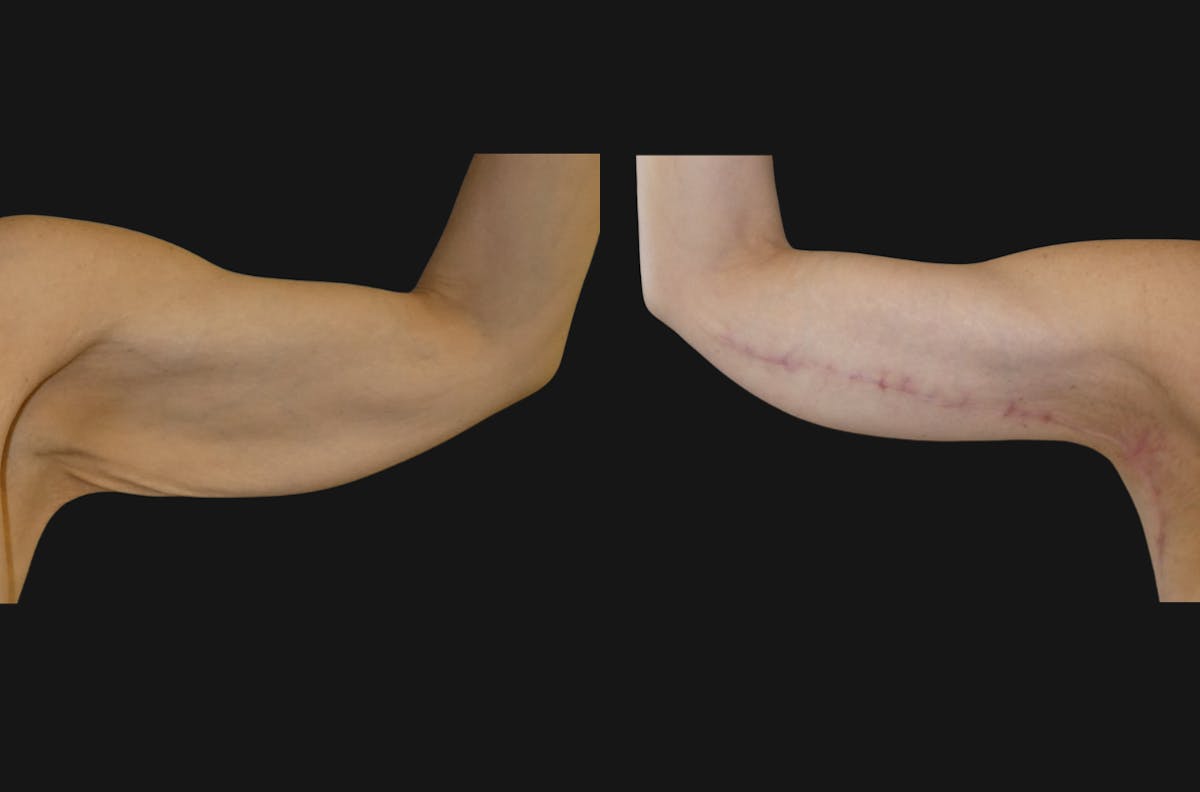 Arm Lift / Thigh Lift Before & After Gallery - Patient 120324 - Image 2