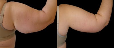 Arm Lift / Thigh Lift Before & After Gallery - Patient 114792 - Image 1