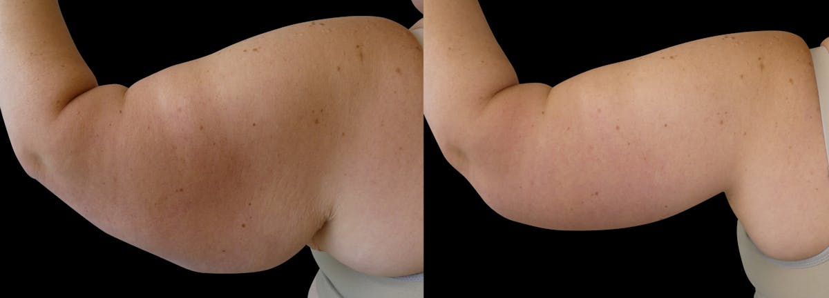 Arm Lift / Thigh Lift Before & After Gallery - Patient 114792 - Image 2