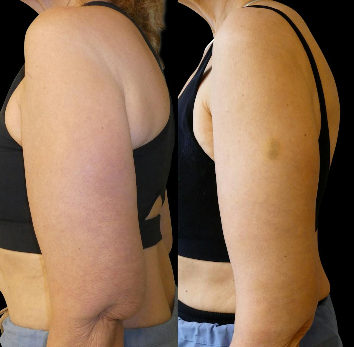 Arm Lift / Thigh Lift Before & After Gallery - Patient 426134 - Image 4