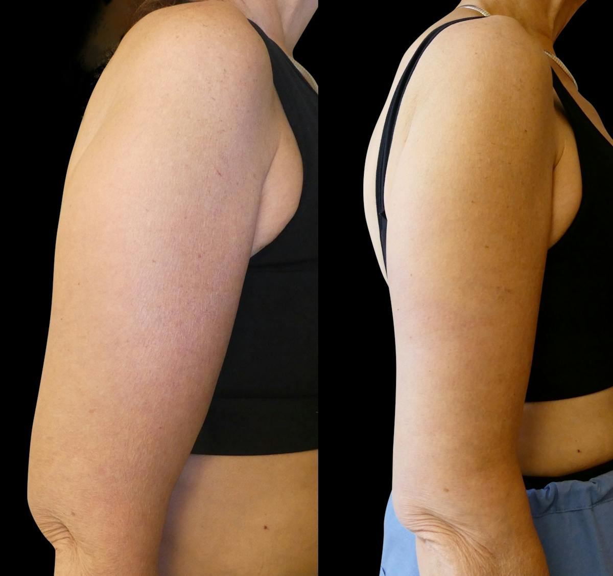 Arm Lift / Thigh Lift Before & After Gallery - Patient 426134 - Image 5