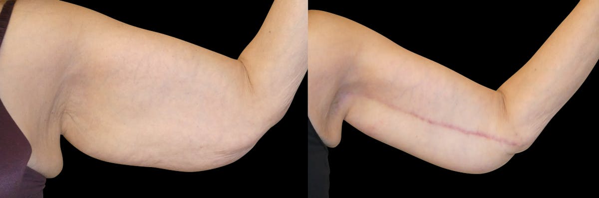 Arm Lift / Thigh Lift Before & After Gallery - Patient 426134 - Image 2