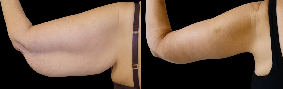 Arm Lift / Thigh Lift Before & After Gallery - Patient 426134 - Image 3