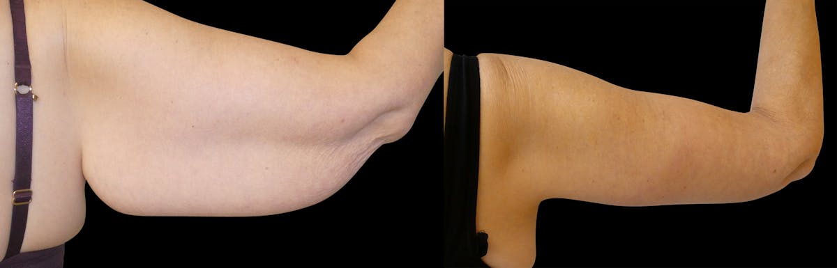 Arm Lift / Thigh Lift Before & After Gallery - Patient 426134 - Image 1