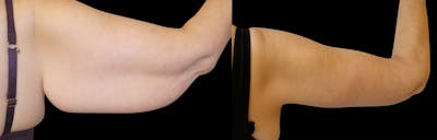 Arm Lift / Thigh Lift Before & After Gallery - Patient 426134 - Image 1