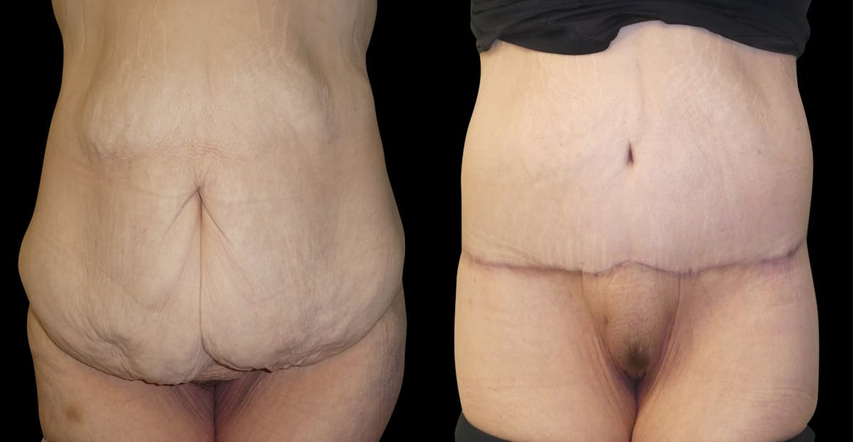 Lower Body / Posterior / Upper Back Lifts Before & After Gallery - Patient 391690 - Image 1