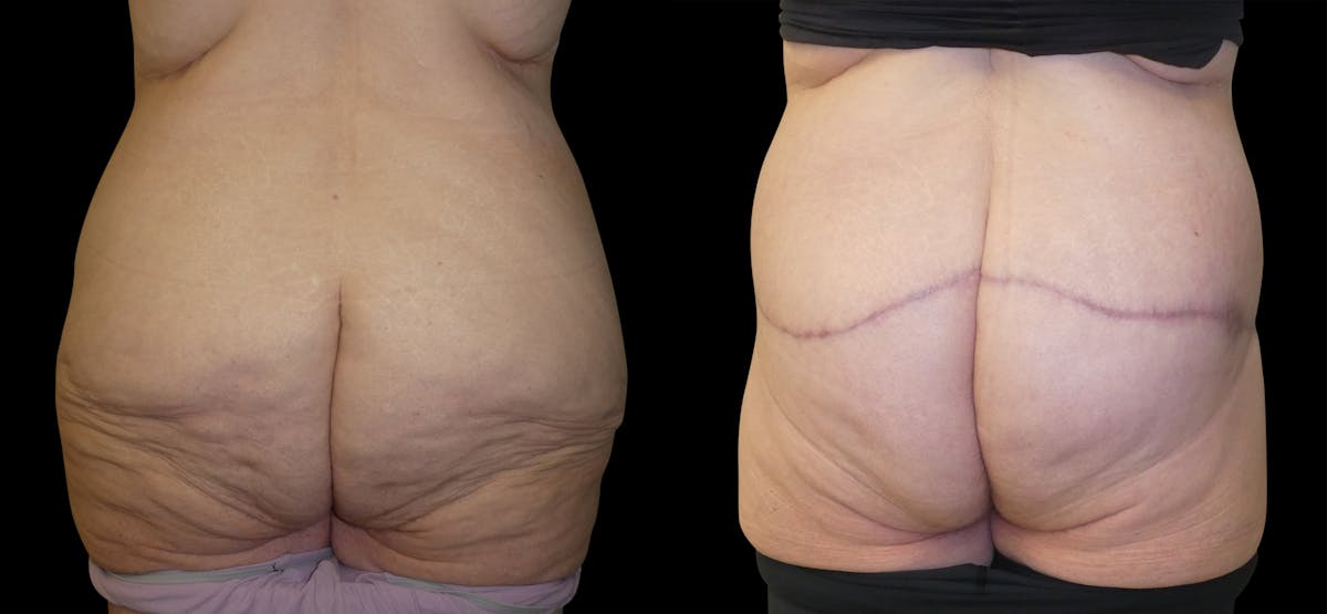 Lower Body / Posterior / Upper Back Lifts Before & After Gallery - Patient 391690 - Image 2