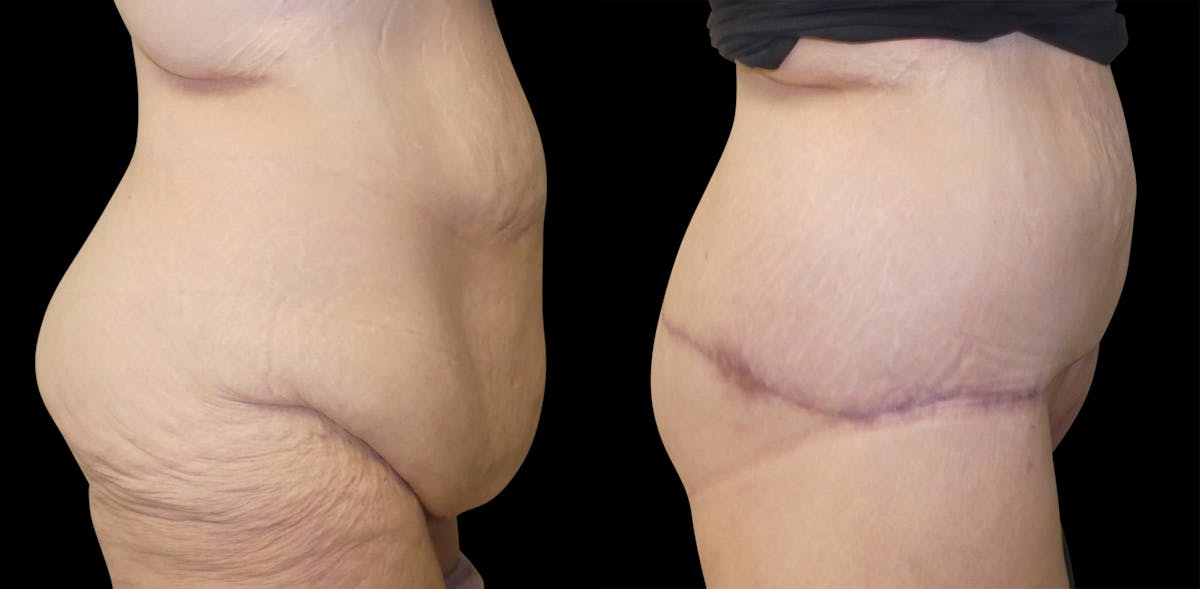 Lower Body / Posterior / Upper Back Lifts Before & After Gallery - Patient 391690 - Image 4