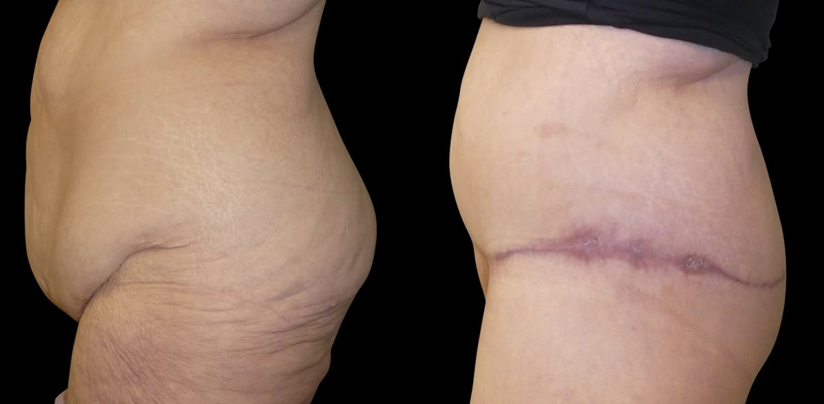 Lower Body / Posterior / Upper Back Lifts Before & After Gallery - Patient 391690 - Image 5