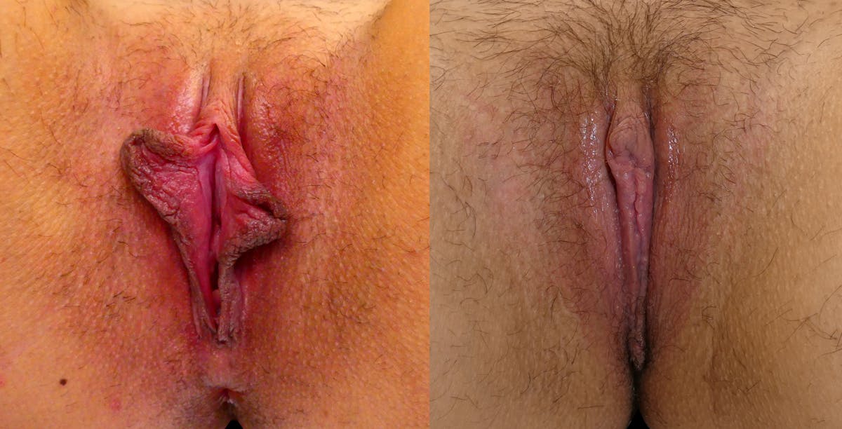 Labiaplasty Before & After Gallery - Patient 346450 - Image 1