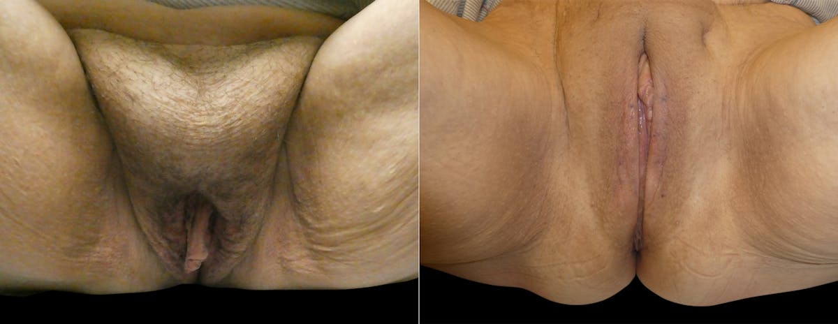 Labiaplasty Before & After Gallery - Patient 365745 - Image 2