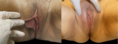 Labiaplasty Before & After Gallery - Patient 365745 - Image 1