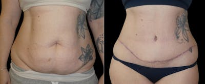 Liposuction Before & After Gallery - Patient 201087 - Image 1