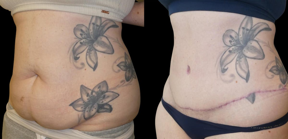 Liposuction Before & After Gallery - Patient 201087 - Image 2
