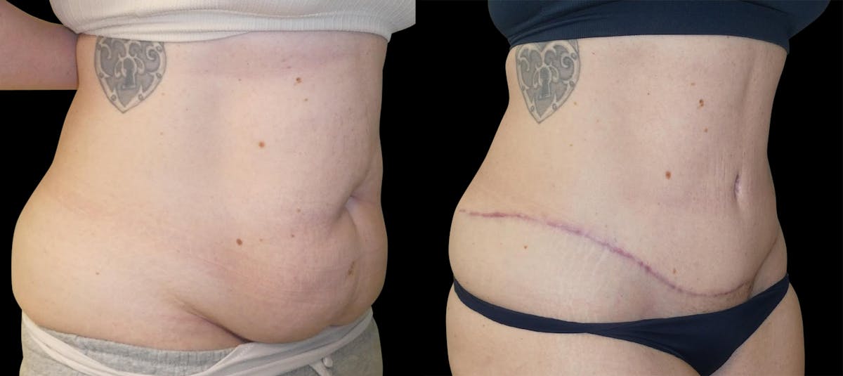 Liposuction Before & After Gallery - Patient 201087 - Image 3