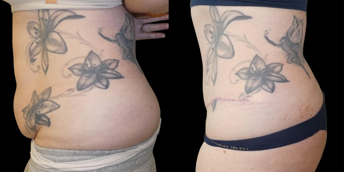 Liposuction Before & After Gallery - Patient 201087 - Image 4