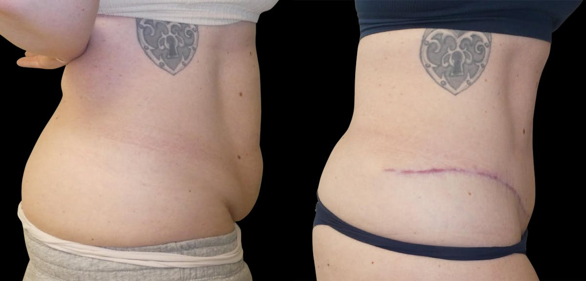 Liposuction Before & After Gallery - Patient 201087 - Image 5
