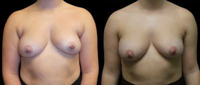 Liposuction Before & After Gallery - Patient 161958 - Image 1