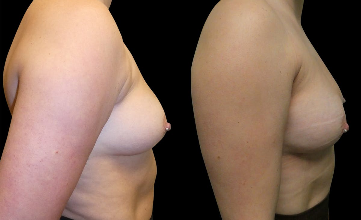 Liposuction Before & After Gallery - Patient 161958 - Image 2