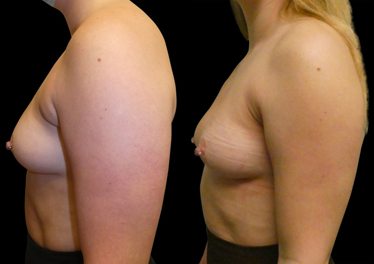 Liposuction Before & After Gallery - Patient 161958 - Image 3