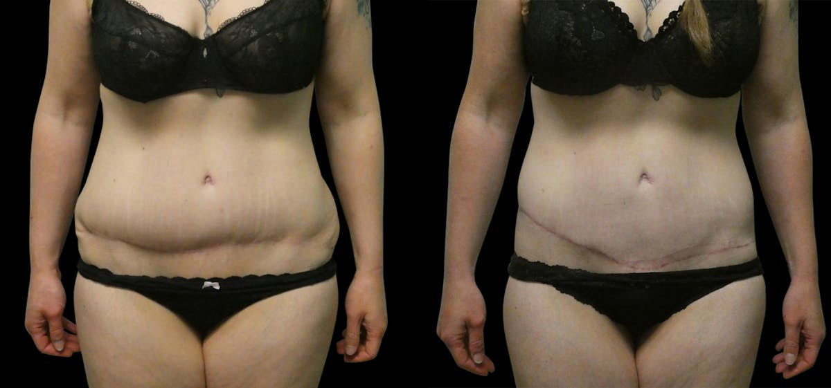 Revision Tummy Tuck Before & After Gallery - Patient 304143 - Image 1