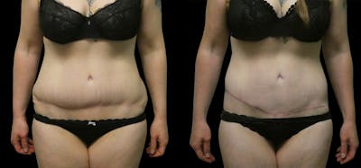 Revision Tummy Tuck Before & After Gallery - Patient 304143 - Image 1