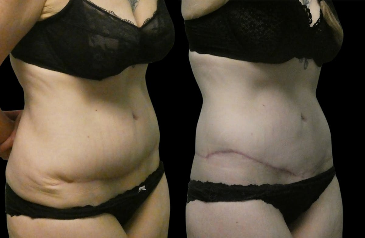 Revision Tummy Tuck Before & After Gallery - Patient 304143 - Image 2