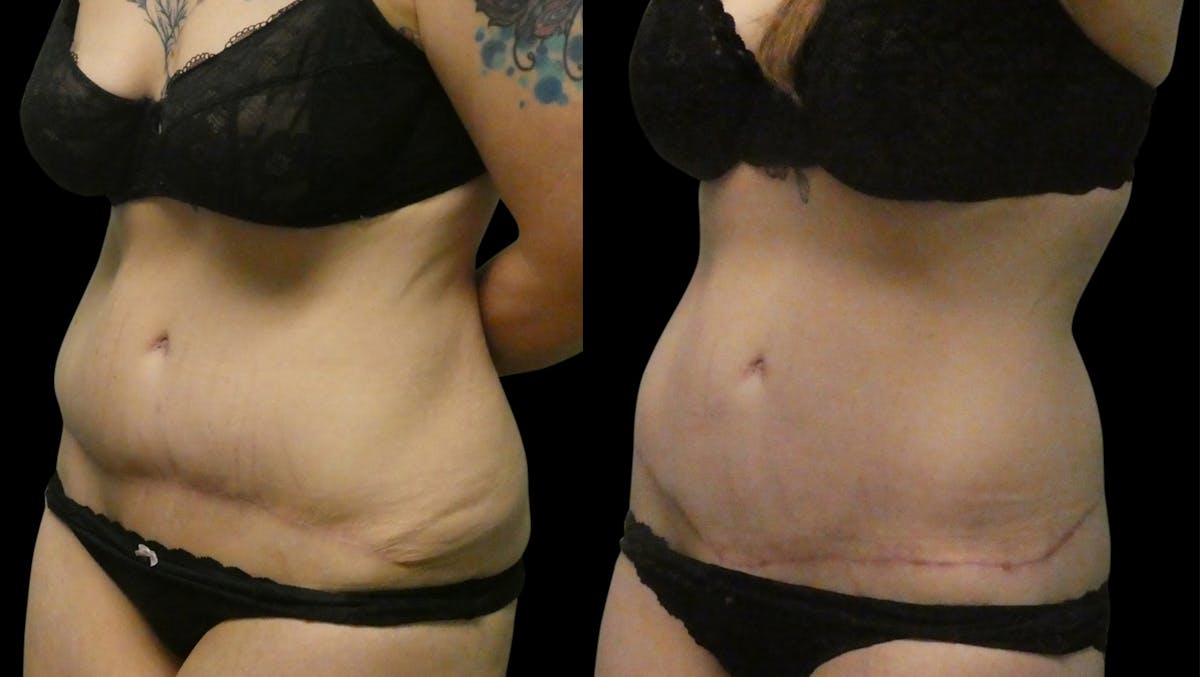Revision Tummy Tuck Before & After Gallery - Patient 304143 - Image 3