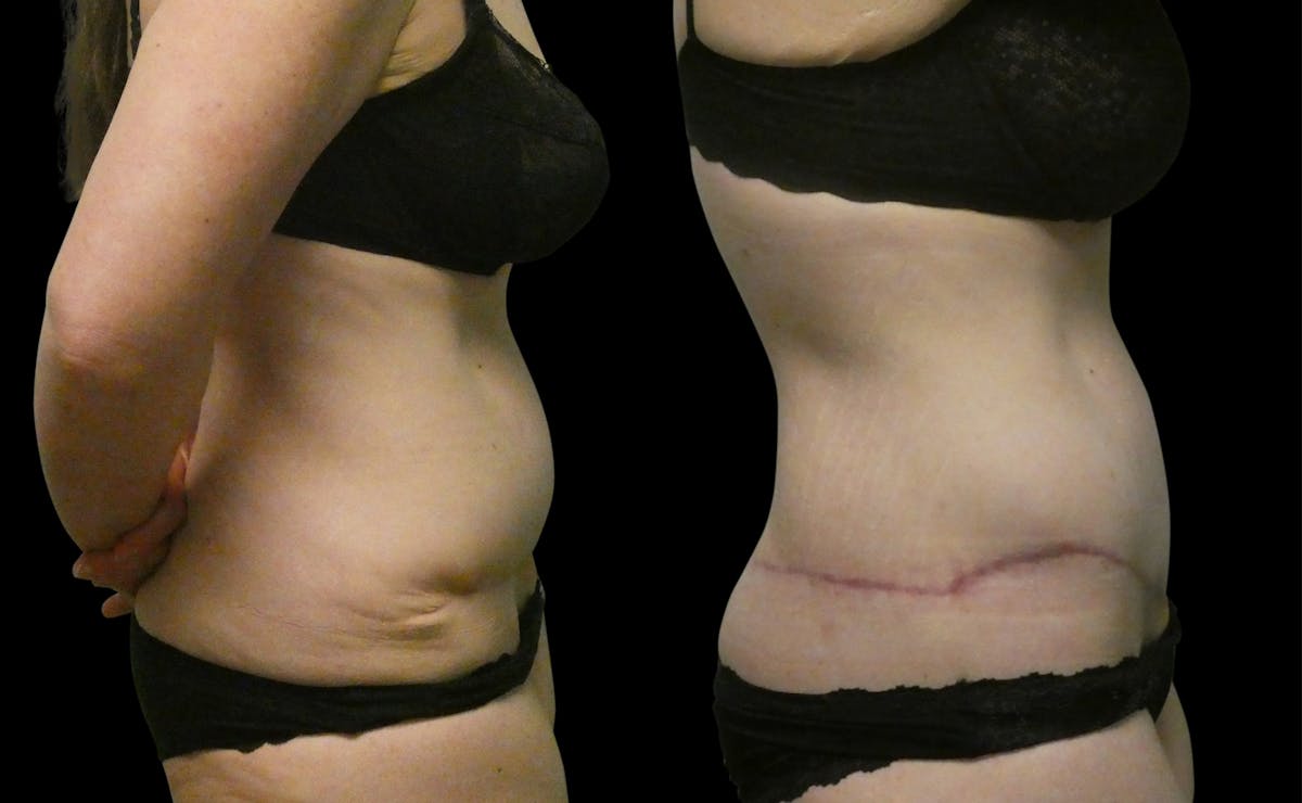 Revision Tummy Tuck Before & After Gallery - Patient 304143 - Image 4