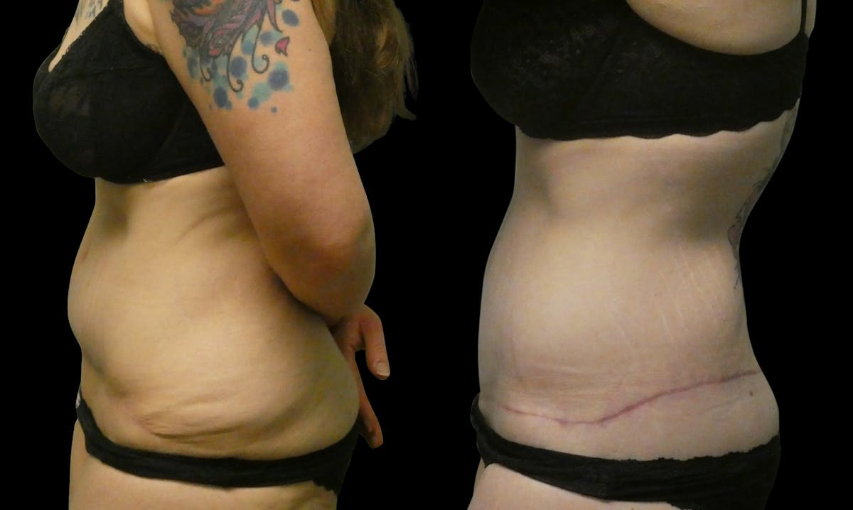 Revision Tummy Tuck Before & After Gallery - Patient 304143 - Image 5