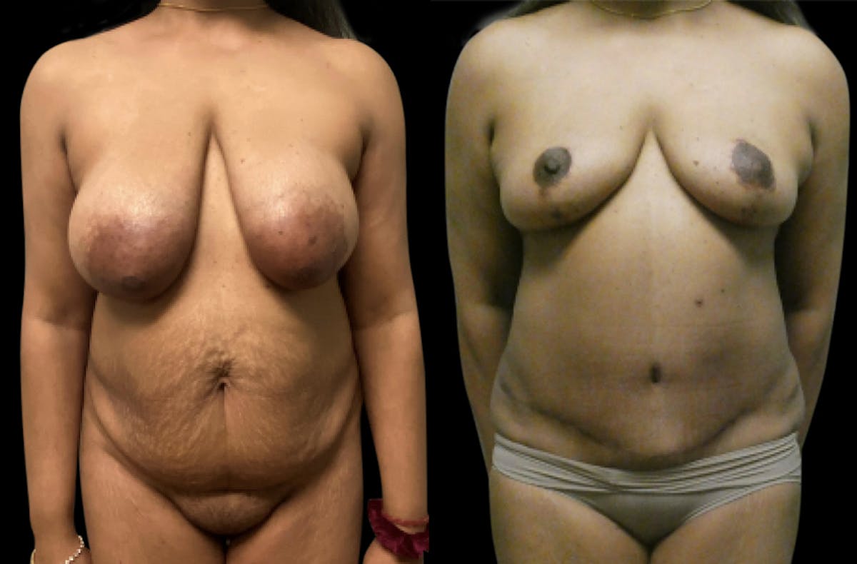 Mommy Makeover Before & After Gallery - Patient 112728 - Image 1