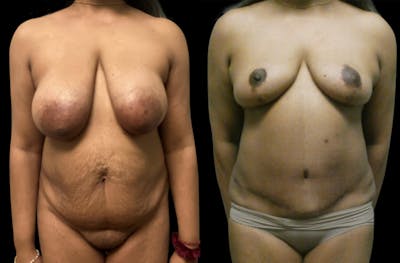 Mommy Makeover Before & After Gallery - Patient 112728 - Image 1