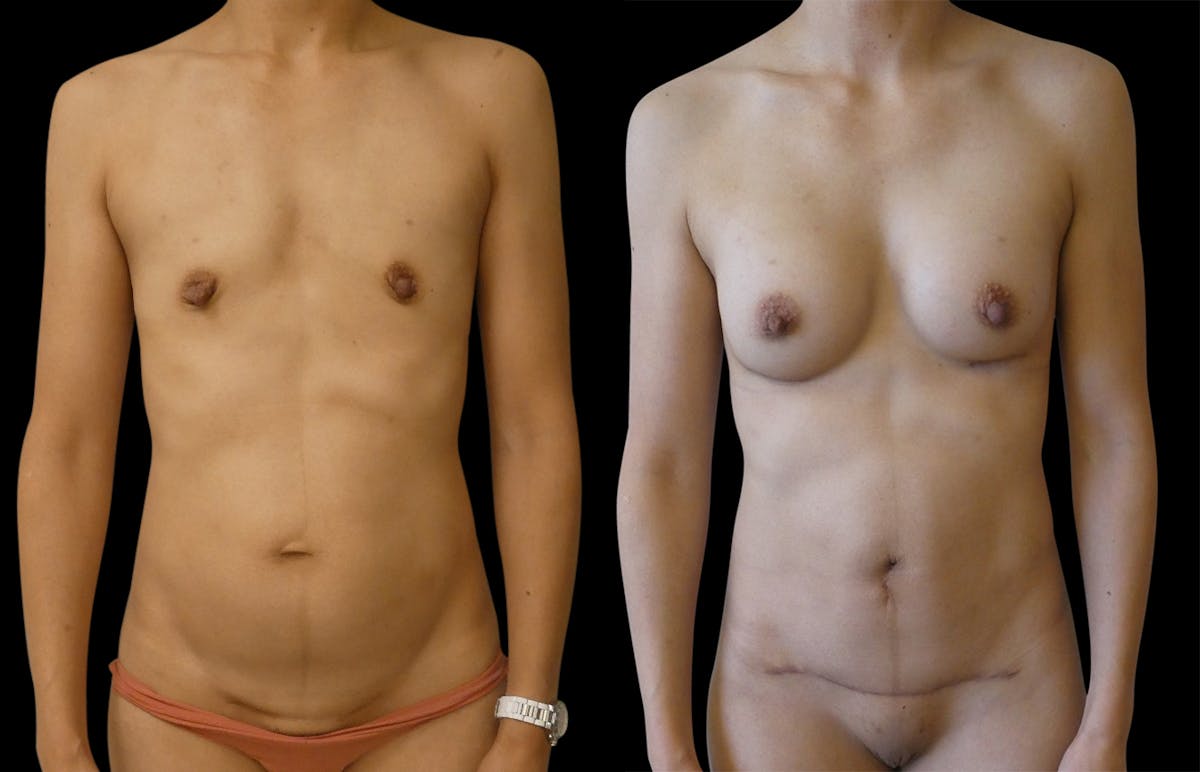 Mommy Makeover Before & After Gallery - Patient 394811 - Image 1