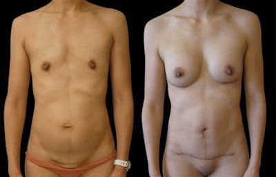 Mommy Makeover Before & After Gallery - Patient 394811 - Image 1