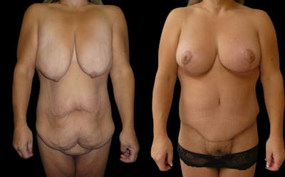 Mommy Makeover Before & After Gallery - Patient 191275 - Image 1