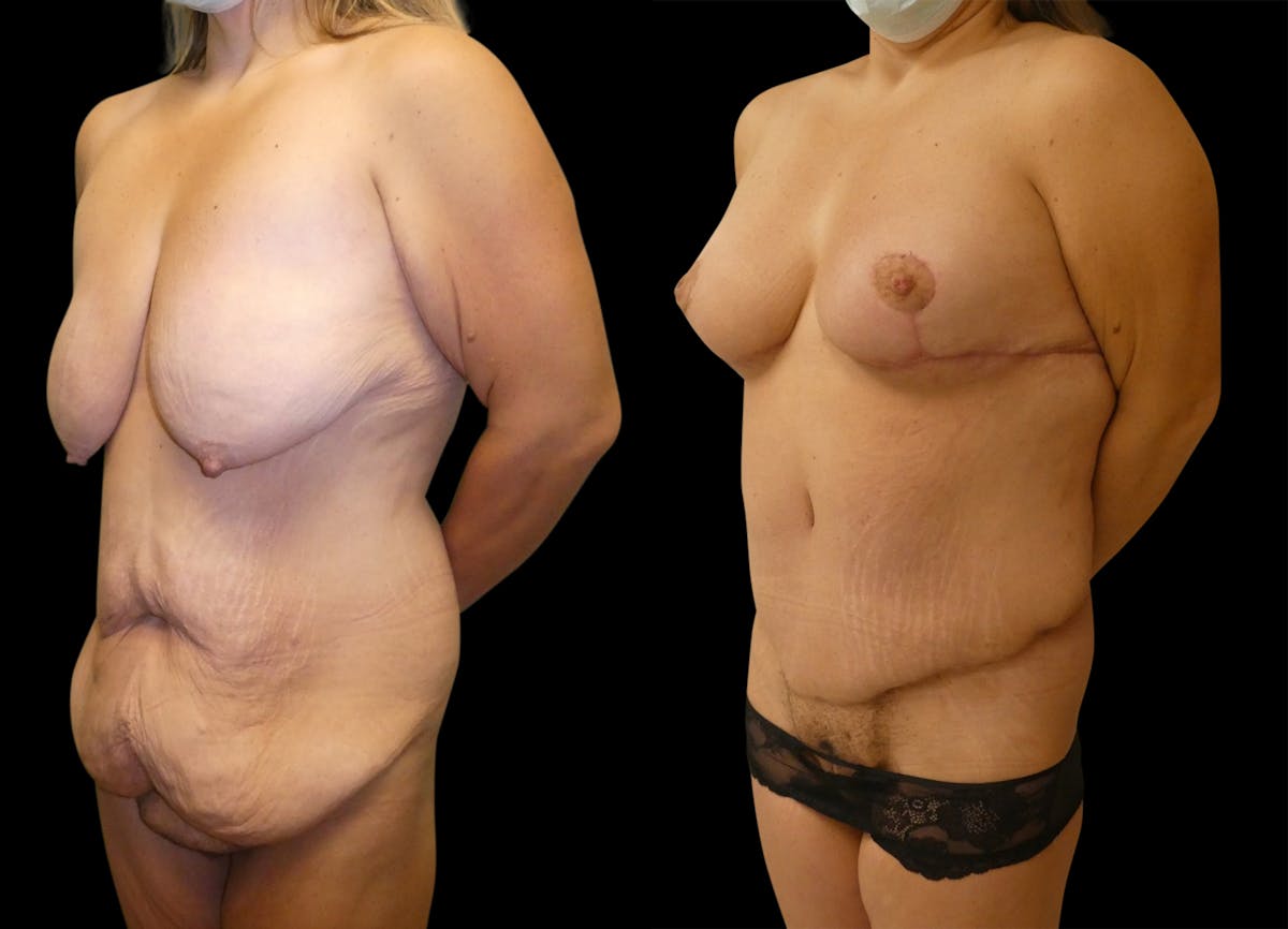 Mommy Makeover Before & After Gallery - Patient 191275 - Image 2