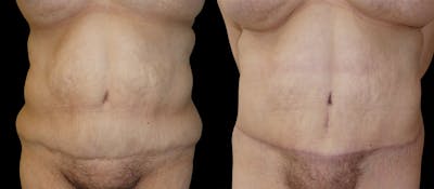 Revision Tummy Tuck Before & After Gallery - Patient 403318 - Image 1