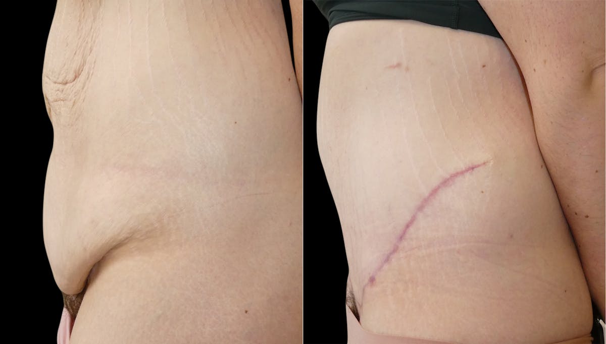 Tummy Tuck / Reverse Abdominoplasty Before & After Gallery - Patient 888037 - Image 4