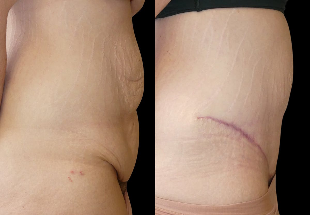 Tummy Tuck / Reverse Abdominoplasty Before & After Gallery - Patient 888037 - Image 5