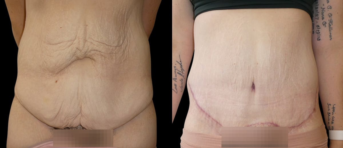 Tummy Tuck / Reverse Abdominoplasty Before & After Gallery - Patient 888037 - Image 1