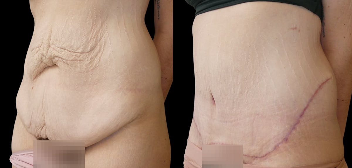 Tummy Tuck / Reverse Abdominoplasty Before & After Gallery - Patient 888037 - Image 2