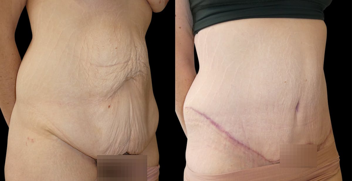 Tummy Tuck / Reverse Abdominoplasty Before & After Gallery - Patient 888037 - Image 3