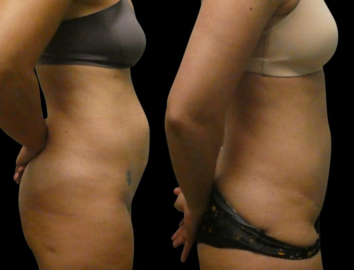 Tummy Tuck / Reverse Abdominoplasty Before & After Gallery - Patient 124526 - Image 2