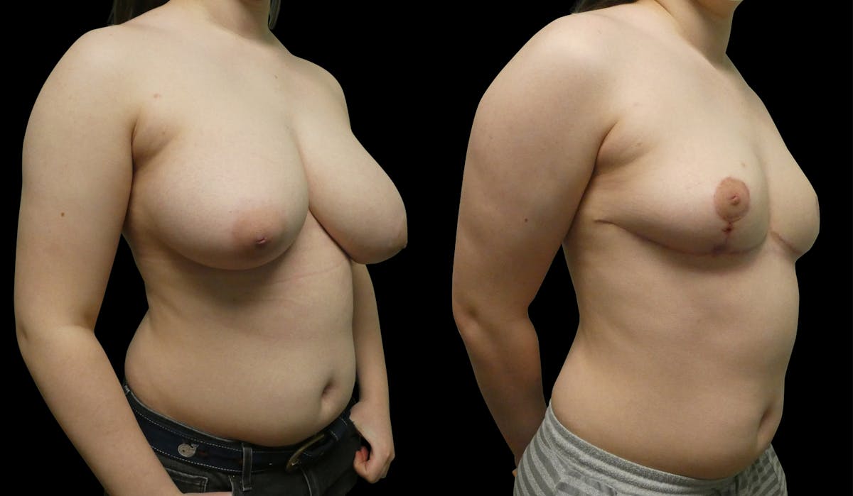 Breast Reduction + Lift Before & After Gallery - Patient 342626 - Image 1