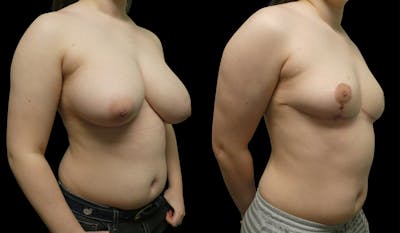 Breast Reduction + Lift Before & After Gallery - Patient 342626 - Image 1