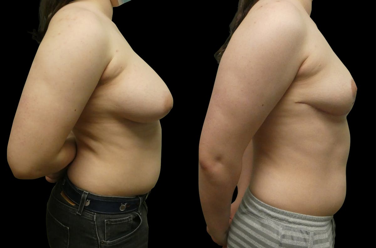 Breast Reduction + Lift Before & After Gallery - Patient 342626 - Image 2