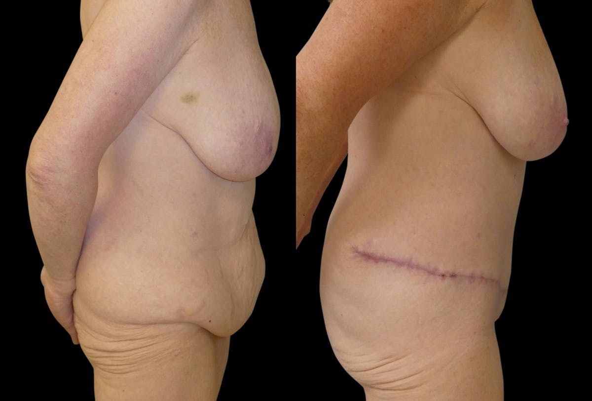 Tummy Tuck / Reverse Abdominoplasty Before & After Gallery - Patient 330616 - Image 4